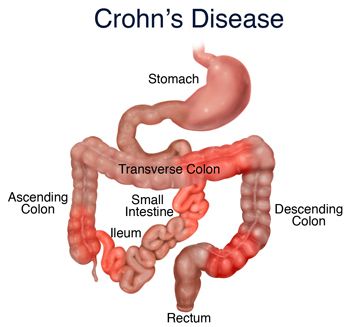 Anatomical illustration showing the stomach and intestines relevant to Crohn's Disease, including the ascending colon, transverse colon, descending colon, ileum, and rectum.