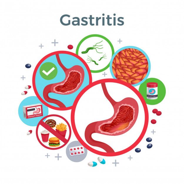 Illustration of gastritis showing stomach inflammation, H. pylori bacteria, unhealthy food, medication, and treatment options.