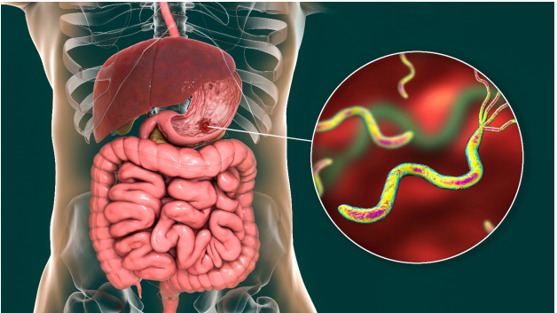 Medical illustration of the human digestive system with a close-up view of Helicobacter pylori (H. pylori) bacteria, highlighting its presence in the stomach lining and its role in digestive health issues.